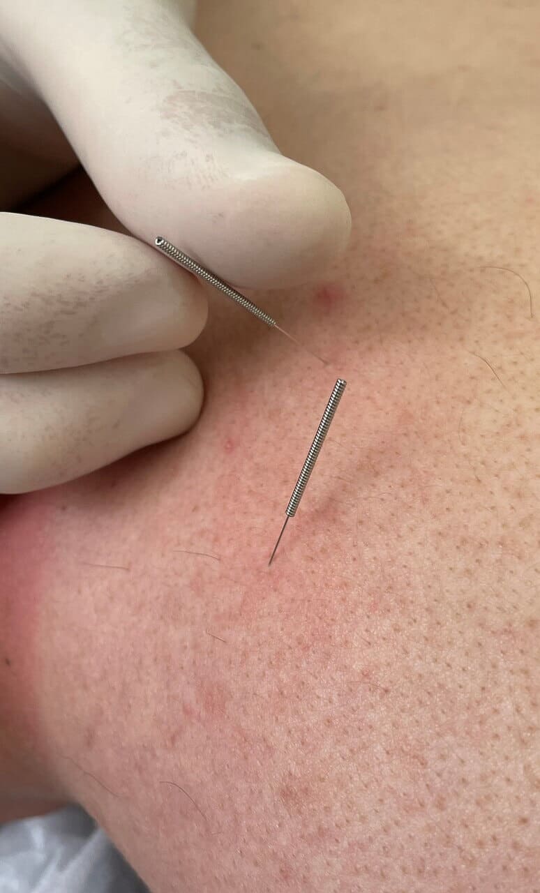 Dry Needling